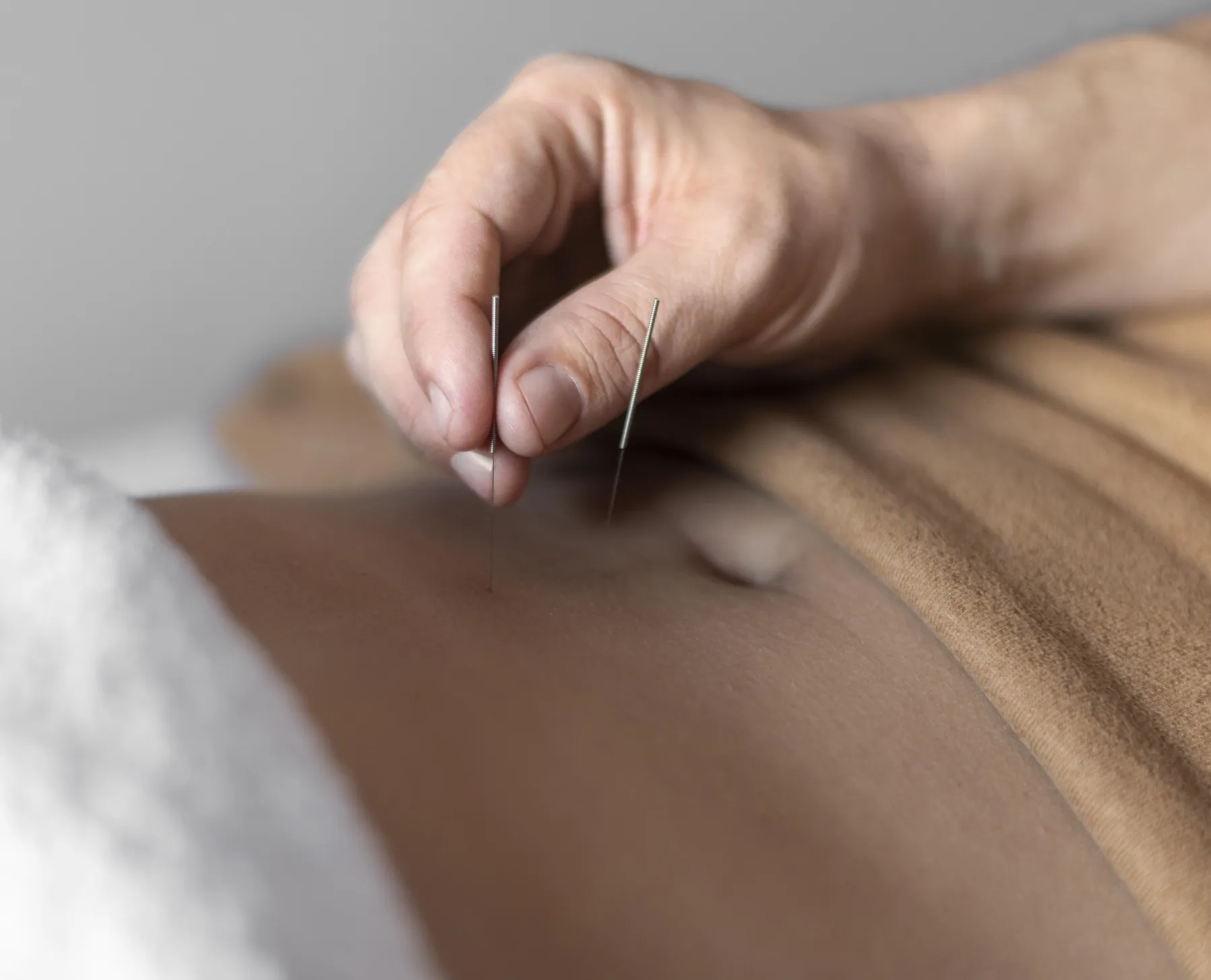Physical therapists are inserting thin acupuncture/dry needling needles into the skin on the patient's belly.