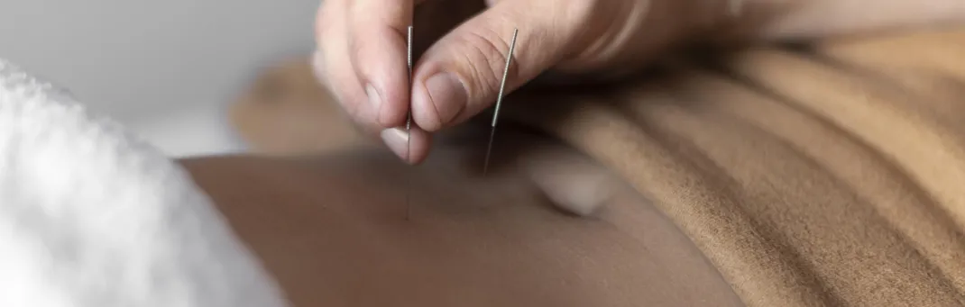 Dry needling therapy: Physical therapist administering treatment for pain relief and mobility recovery at rehabilitation clinic